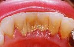 Зубной камень - описание, профилактика