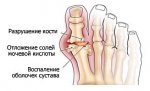 Как избавиться от «косточек» и деформаций пальцев ног